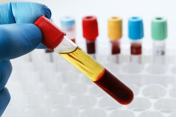 Platelet-Rich Plasma (PRP) & Stem Cell Therapy